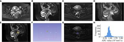 Whole-tumor histogram analysis of apparent diffusion coefficients for predicting lymphovascular space invasion in stage IB-IIA cervical cancer